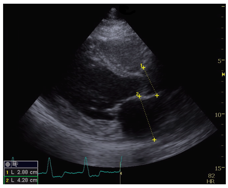 Automatic Extraction of Measurements in Echocardiogram Examinations - SIBGRAPI WUW 2017
